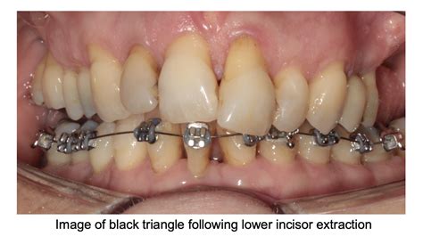  The arch of the lower incisors is rounded