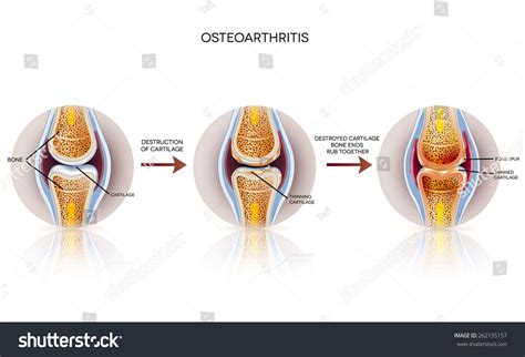 The arthritic joint has damaged cartilage that is unable to absorb shock and allows the two bone surfaces to rub against each other, causing inflammation of the joint, pain, and distress in the dog