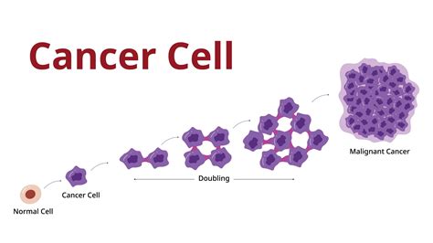  The cancer cells begin to spread throughout the body at that point, a process known as metastasis