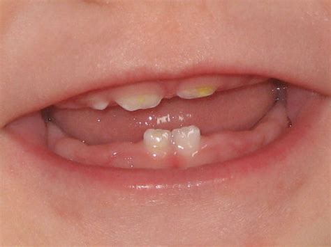  The chewing helps to dislodge the baby teeth when the new permanent teeth are coming through