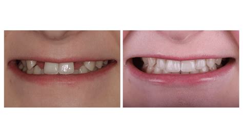  The gap between the upper and lower incisors should not be so large that the upper and lower lips do not meet
