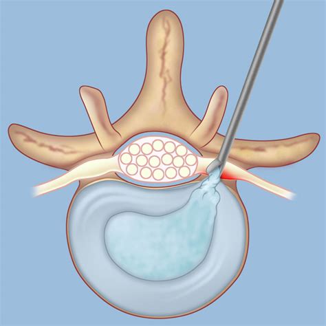 The goal of the surgical procedure is to remove the slipped disc, which relieves the spinal cord pressure