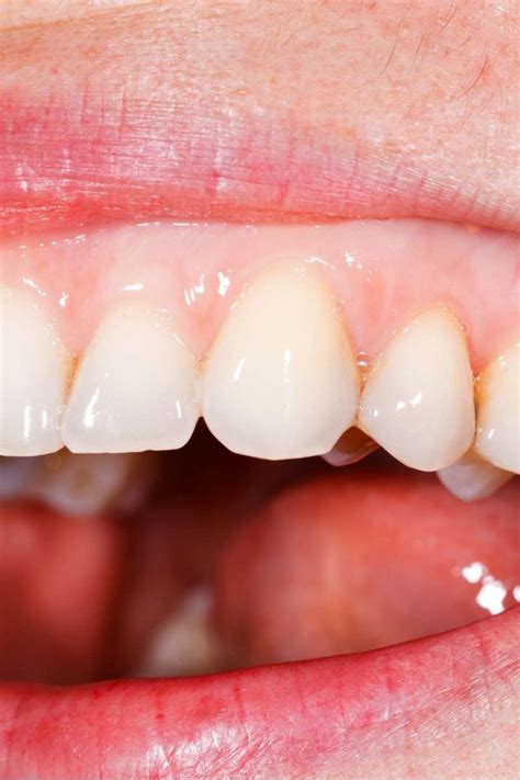  The gums may appear pale, demonstrating a lack of oxygen, accompanied by shallow breathing and a rapid heartbeat