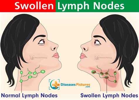  The lymph nodes undergo rapid and non-painful enlargement over three to 10 times their normal size