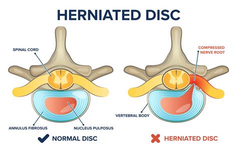  The more dehydrated the discs, the more likely they are to herniate