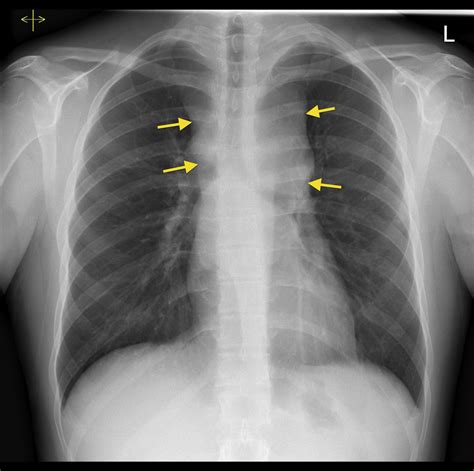  The most noticeable physical change will be the widening of the chest, a sure tell sign of a 2 year old adult