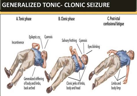  The most recognized form is the tonic-clonic or grand mal seizure, where the dog might fall to the side, become stiff, and paddle their legs