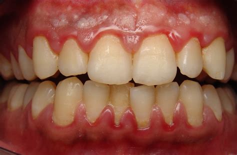  The redness of his gums is significantly reduced, the lesions are no longer reddish, and his skin is much less flaky