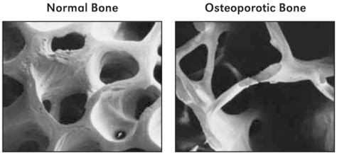  The site will appear blurry or look like there is bone missing from the area due to cancer destroying normal bone tissue
