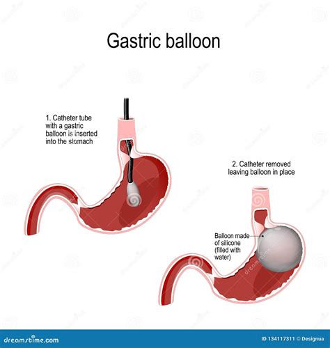  The stomach area may become stiff and balloon-like to the touch