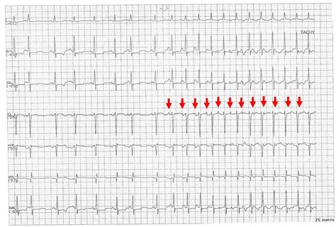  The tachycardia gradually increases and decreases without an abrupt onset or break