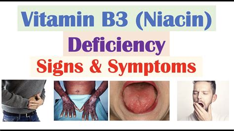  The therapeutic use of niacin often is limited by dermatologic and gastrointestinal ADRs e