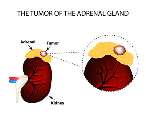  The vet may remove the tumor from the adrenal gland or pituitary gland to reduce the production of the cortisol hormone
