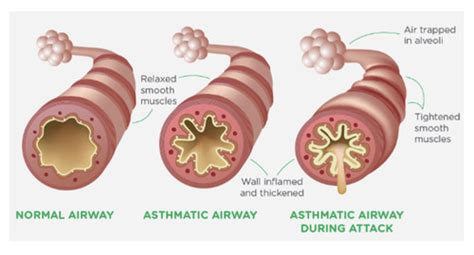  Their airways are obstructed to varying degrees and can cause anything from noisy or labored breathing to total collapse of the airway