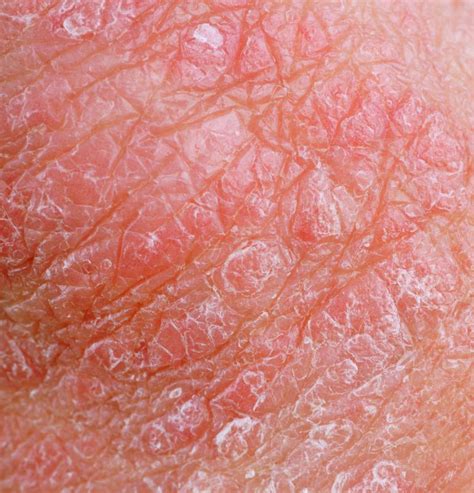  Their skin may be dry and cracked, and they may develop sores on their skin