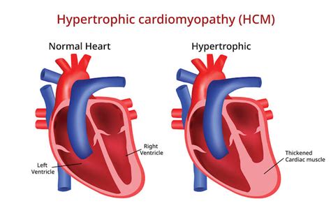  There are two main types of feline cardiomyopathy: Hypertrophic cardiomyopathy — Usually hereditary, this condition is characterized by a thickened left ventricle lower chamber