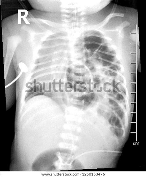  There is also a rare congenital disease that allows abdominal organs to enter the thorax where the lungs are, pushing on them — we can correct this with surgery