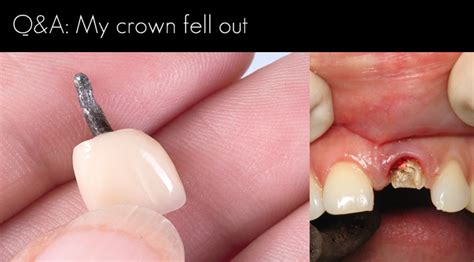  This allows the crown of the tooth to fall out