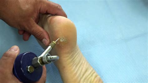  This can be done with a scalpel, laser, or through cryosurgery using intense cold to destroy the wart