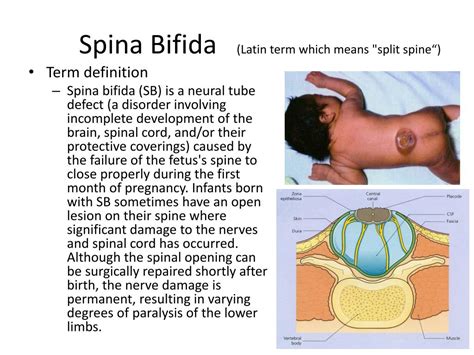  This causes deformity of the spine and is present at birth