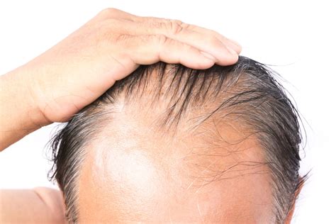 This condition causes patches of hair to thin and fall out