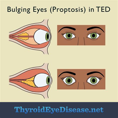  This condition is called ocular proptosis