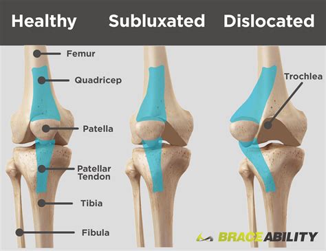  This is a painful condition where the kneecap dislocates or develops in an abnormal position