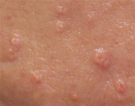  This is a skin condition where the sebaceous glands become inflamed and can eventually be destroyed