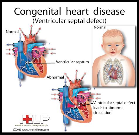  This may indicate that congenital present at birth heart disease is present