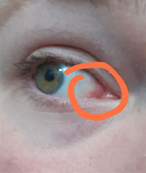  This often appears as a pink or reddish round mass at the inner corner of the eye