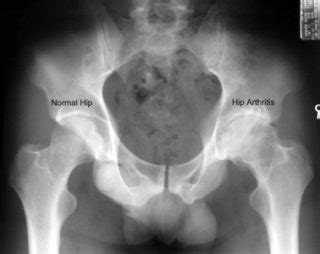  This results in arthritis of the hips, often at a young age