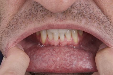  This type of cancer is most often found in the mouth gums, lips, palate and feet but can occur anywhere on the body
