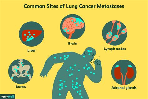  This type of cancer is typically aggressive and can spread metastasize if not treated
