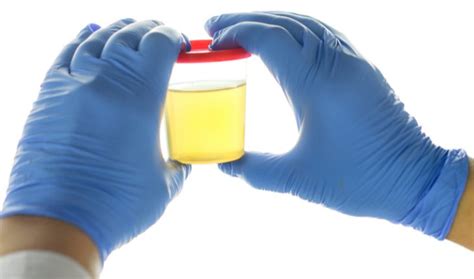  To prevent tampering with or contaminating a urine sample, you may be monitored or observed while collecting urine