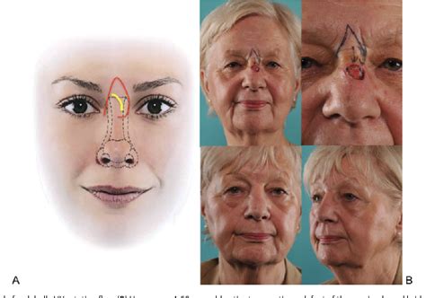  Total reconstruction may be required to restore the structure of the nose