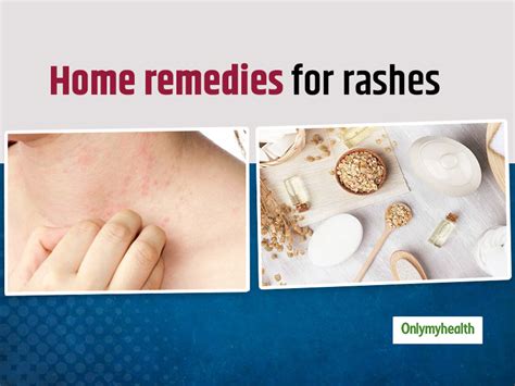  Treating rashes involves isolating the cause and removing it or treating it