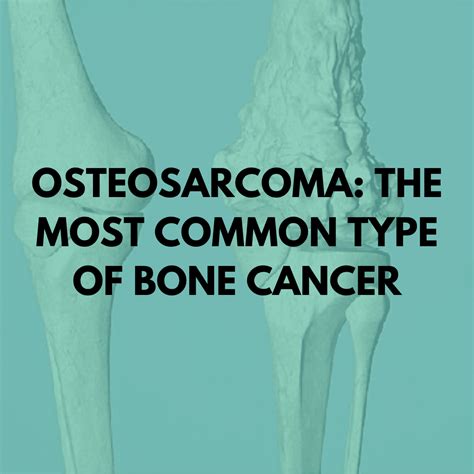  Treatment for osteosarcoma depends on how far the cancer has progressed