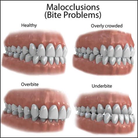  Underbite where the lower teeth overlap the upper teeth and too-crowded teeth can lead to chewing difficulties, infection and, in time, periodontal disease