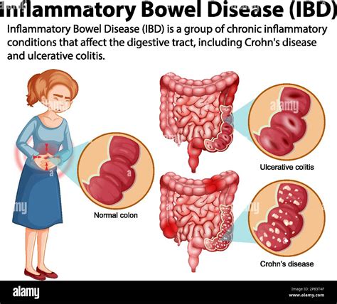  Underlying conditions or diseases such as inflammatory bowel disease IBD can also cause diarrhea