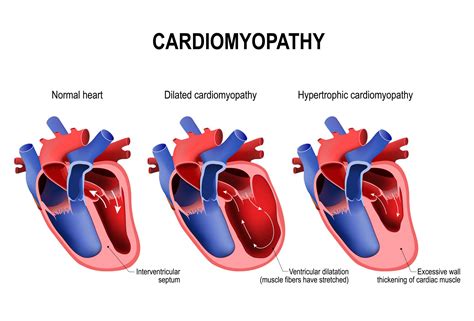  Unlike HCM, restrictive cardiomyopathy does not cause ventricular wall thickening