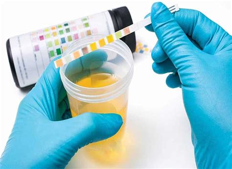  Urinalysis drug screening uses urine from the test subject to detect the metabolic markers of drug use