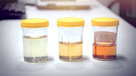  Urine is the most common sample used