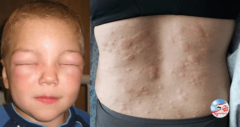  Urticaria may progress to anaphylaxis, which is considered life-threatening