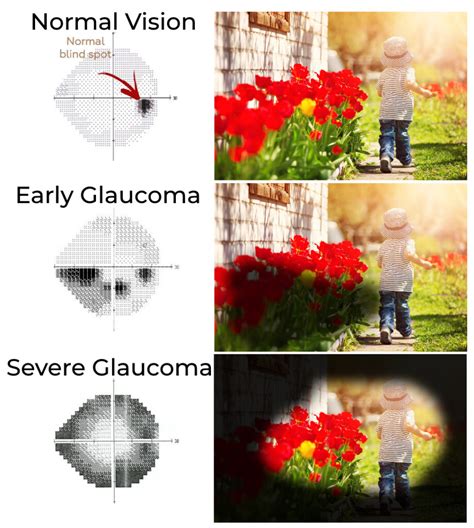  Vision loss is common in this final stage