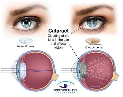  What are cataracts? Cataracts form in the lens of the eye