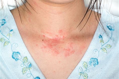  What are the allergy symptoms? These reactions can be indicated by itchy skin, rash, constant and excessive licking, vomiting, and infections