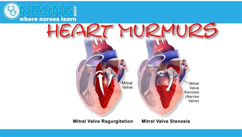  What causes a heart murmur? A heart murmur is caused by turbulent blood flow within the heart