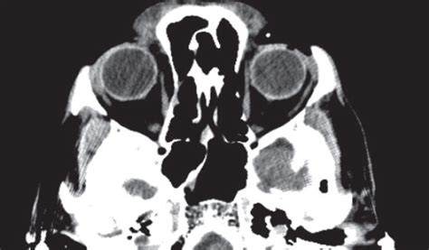  While much of the defect can be seen with the naked eye, a CT scan on the day of surgery showed how extensive the lesion was in the bone