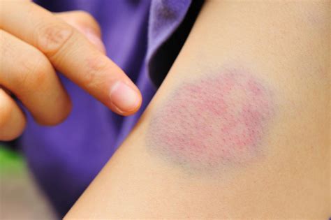  You may have slight pain or bruising at the spot where the needle was put in, but most symptoms go away quickly