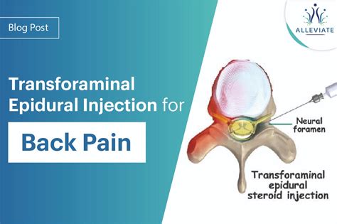 0722 Transforaminal Epidural Injections - Aetna